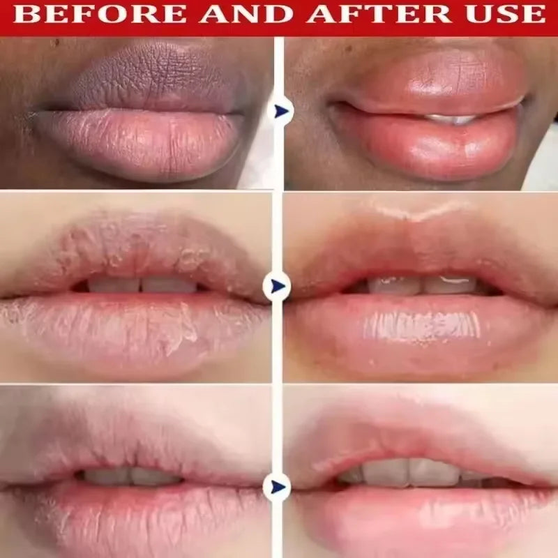 Moisturizing Lip Balm Serum For Dark Lip Removal Fast Acting
