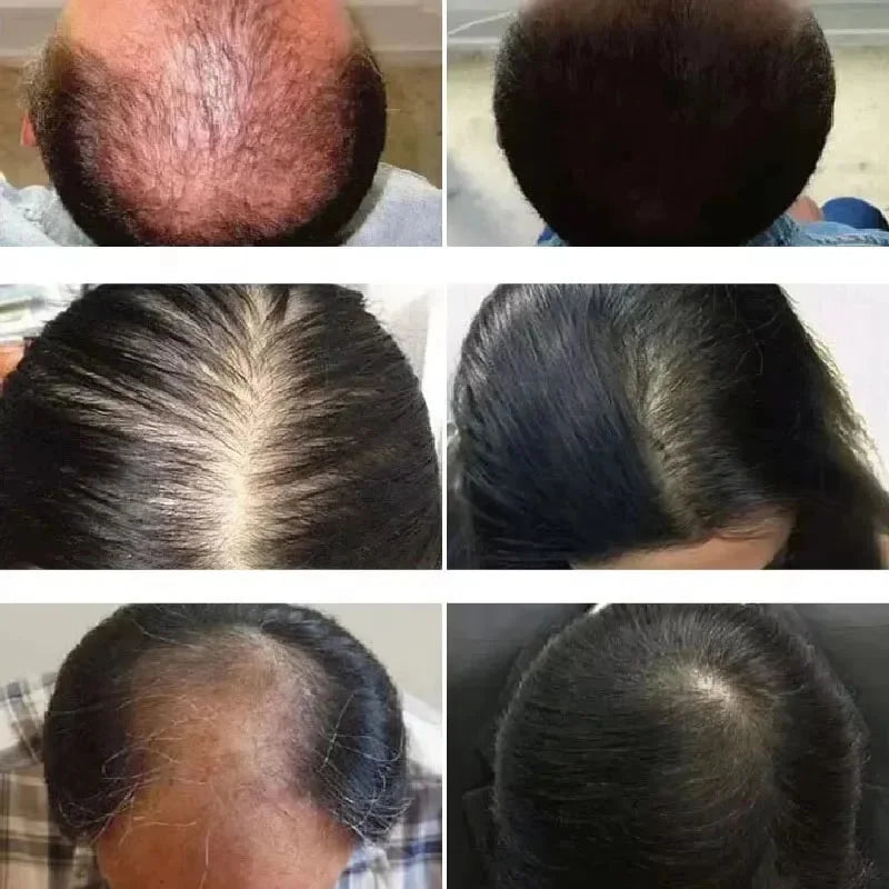 Ouhoe Hair Growth Oil For Anti Hair Loss Treatment